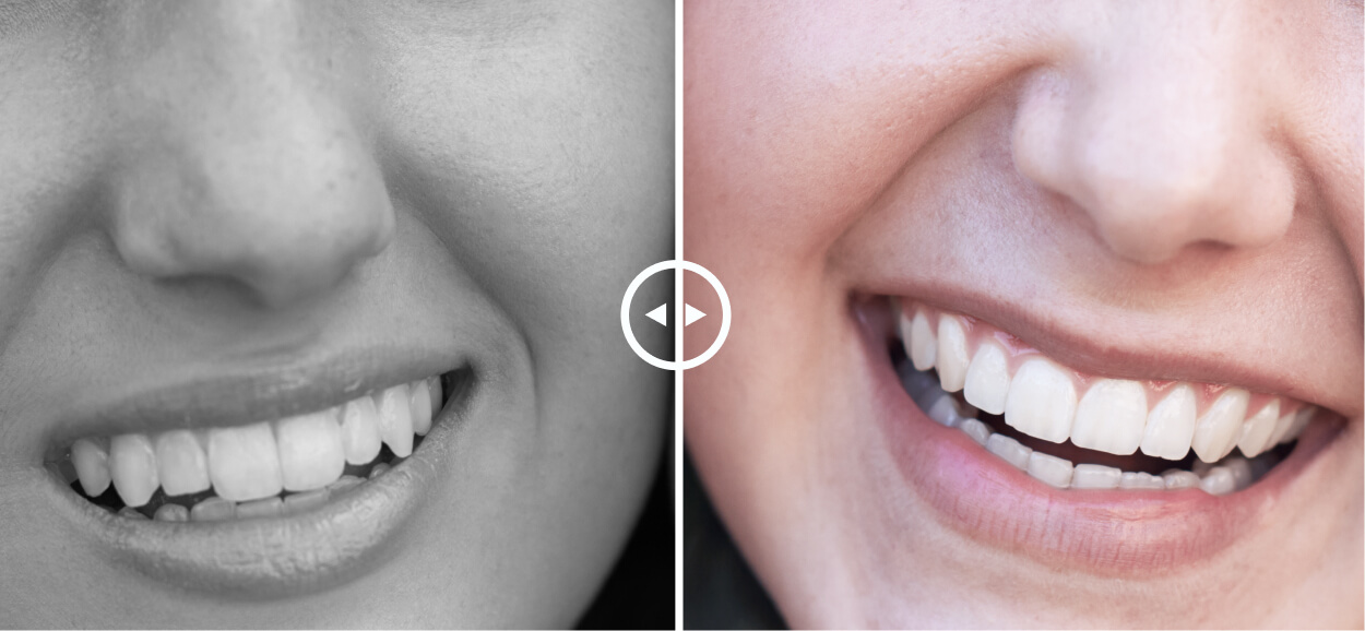 Single Before-After Photo