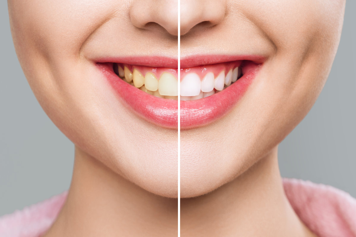 A stunning smile transformation showcasing the impressive results of effective teeth whitening treatments