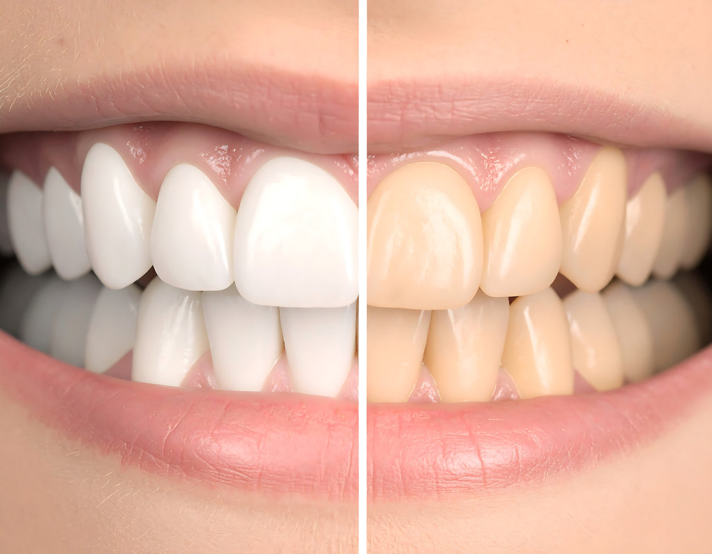 Compare teeth whitening before and after dental care comparison