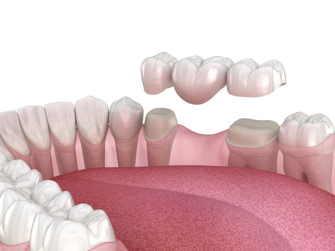 Dental bridge of 3 teeth over molar and premolar. Medically accurate 3D illustration of human teeth treatment
