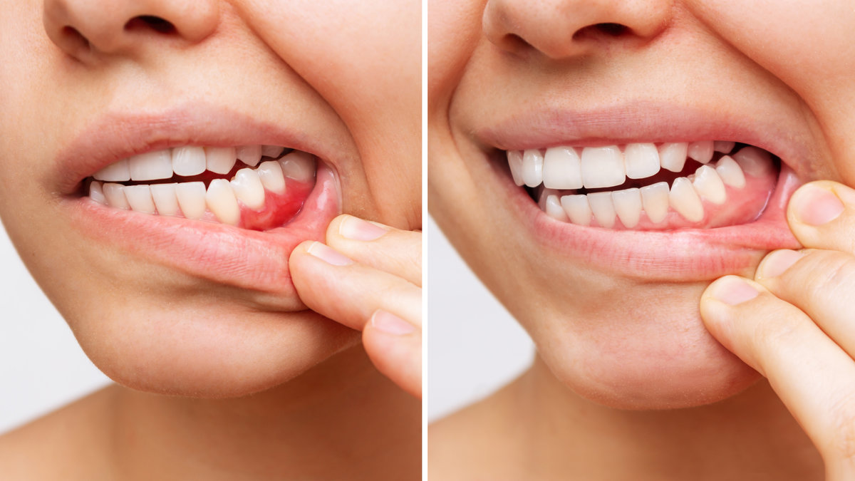 Two shots of a young woman with red bleeding gums and health gums, before and after treatment on a white background. Result of curing of gum inflammation. Close up. Dentistry, dental care. Comparison