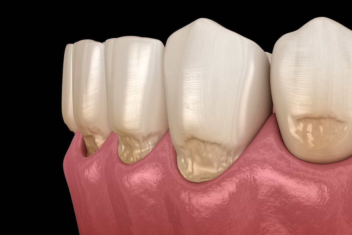 Abfraction of anterior teeth. Medically accurate 3D illustration